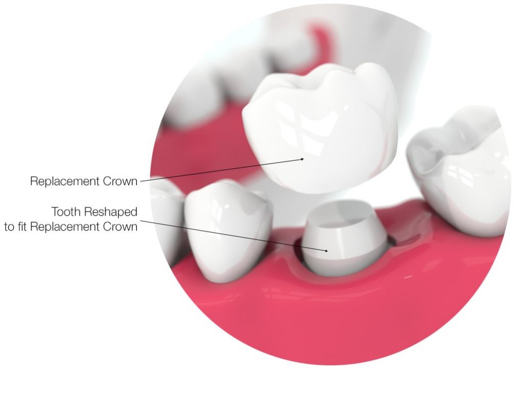 Dental Crowns Archer Dental