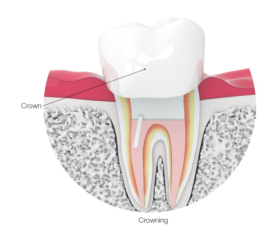 root canal treatment with dental crown graphic