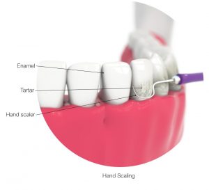 teeth cleaning how much