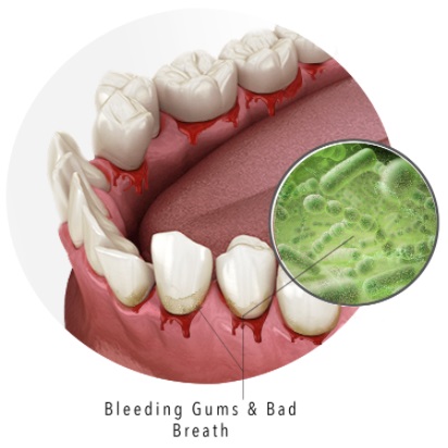 bad breath gum disease tartar