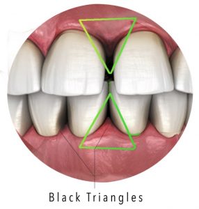 Black Triangles from gum disease