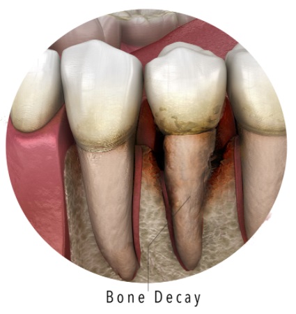 bone decay from advanced gum disease