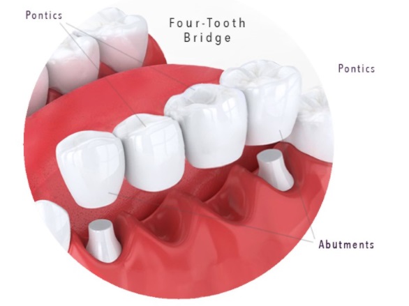 four tooth bridge at Archer Dental