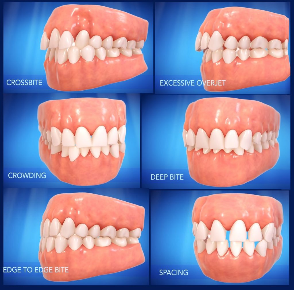 different bites to be corrected by Invisalign 