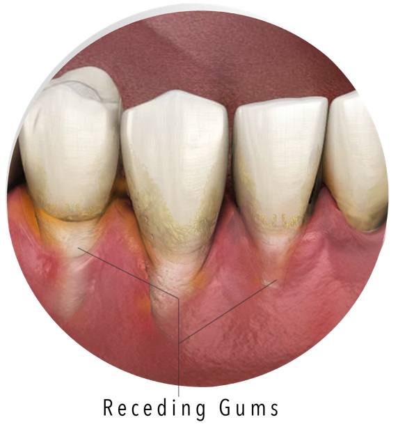 Receding gums from periodontal disease