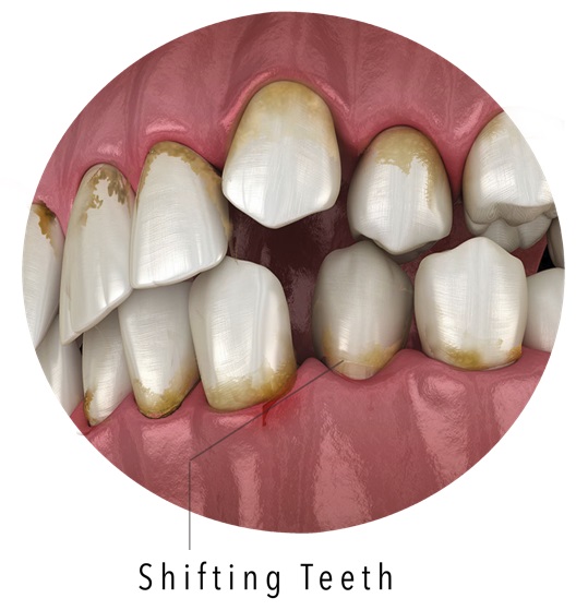 shifting teeth from gum disease
