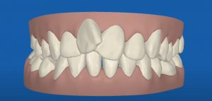 Crooked teeth alignment Invisalign therapy Toronto