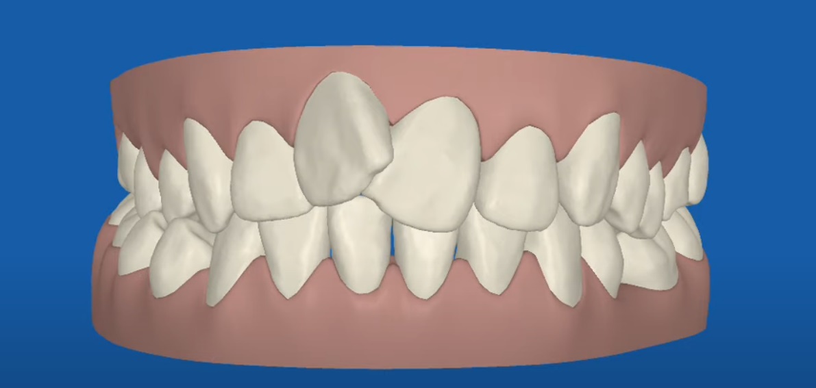 Crooked teeth alignment Invisalign therapy Toronto