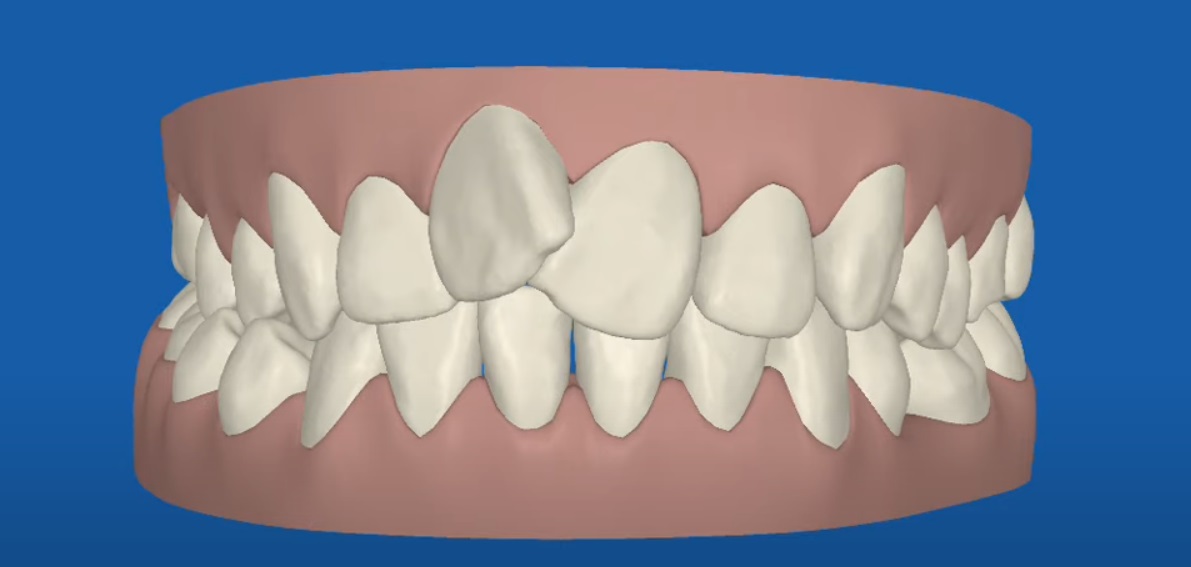 Invisalign Cost Canada