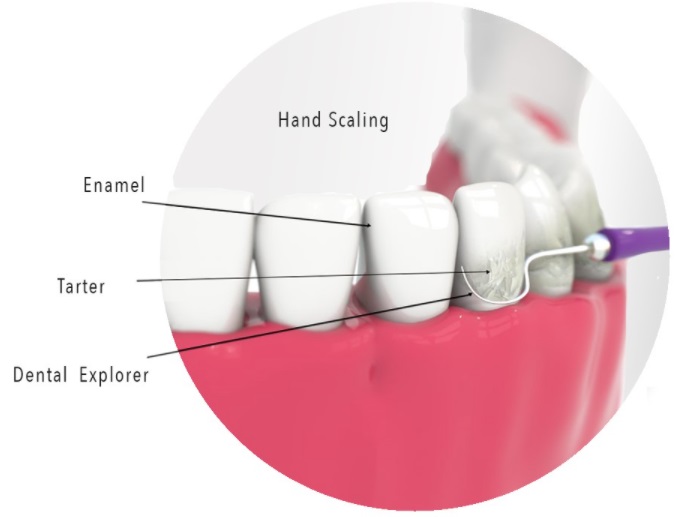 hand scaler showing plaque on enamel and dental explorer