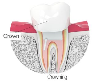 crowning a ceramic crown