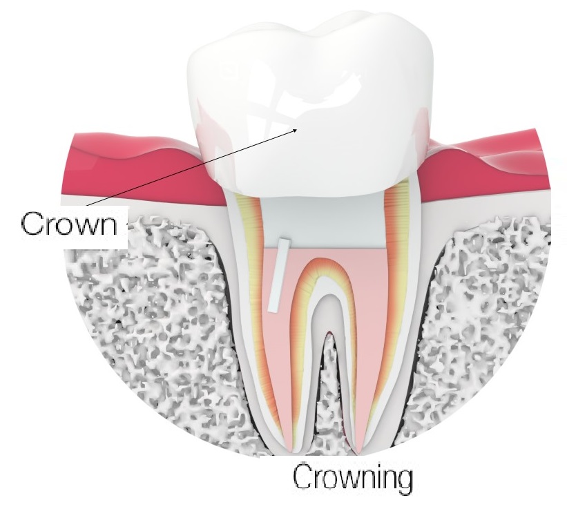 crowning a ceramic crown
