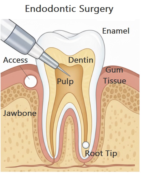 Root Canal Surgery (Endodontic therapy) at Archer Dental