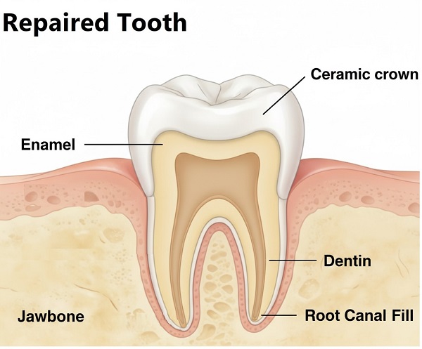 repaired tooth with ceramic crown at Archer Dental
