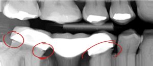 Dental Bridge X-ray