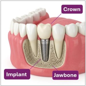 Dental implant for single tooth