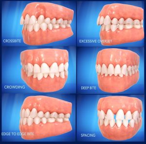 common orthodontic treatments at Archer Dental