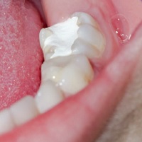 Light sensitive material used to seal teeth after surgery.