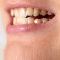  A medical condition in which teeth migrate from optimal bite.