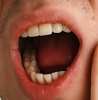 wisdom tooth pain