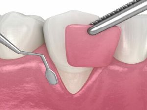 soft tissue periodontics