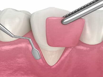 soft tissue periodontics
