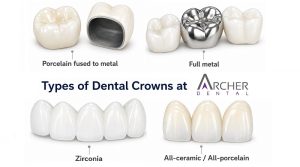 Tooth crown material